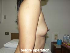 plastic-surgery-breast-augmentation 